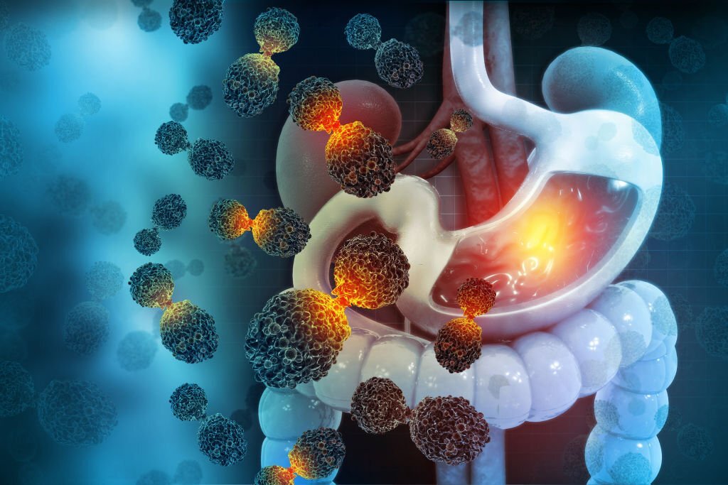 Stomach cancer. Cancer attacking cell. Stomach disease concept. 3d illustration Herbal supplements and detox teas used in our detoxification therapy for your well-being